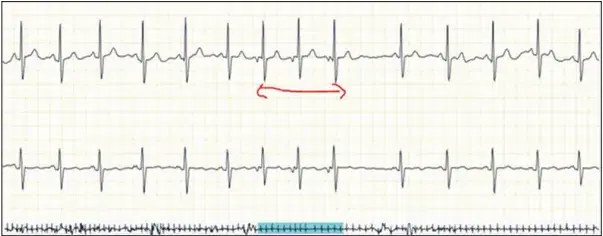 atrial-tachycardia